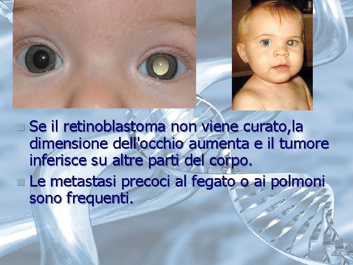 Se il retinoblastoma non viene curato, la dimensione dell'occhio aumenta e il tumore inferisce Se il retinoblastoma non viene curato, la dimensione dell'occhio aumenta e il tumore inferisce