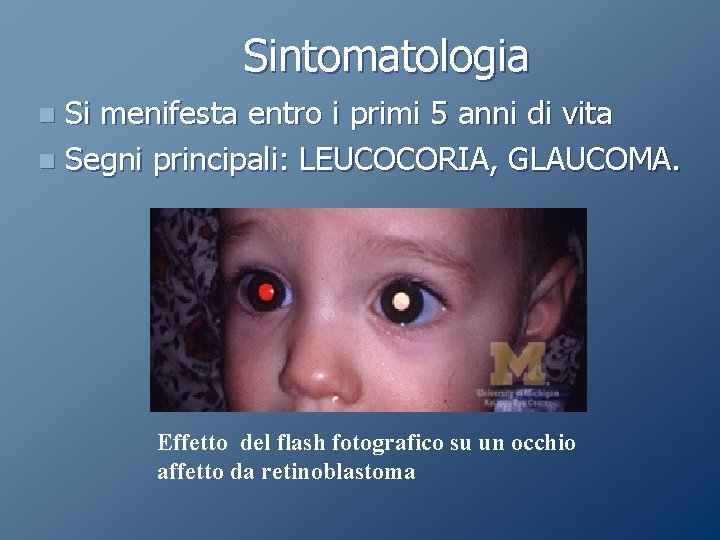 Sintomatologia Si menifesta entro i primi 5 anni di vita n Segni principali: LEUCOCORIA, Sintomatologia Si menifesta entro i primi 5 anni di vita n Segni principali: LEUCOCORIA,