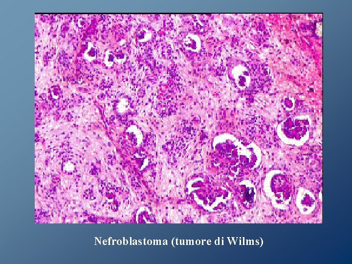 Nefroblastoma (tumore di Wilms) Nefroblastoma (tumore di Wilms)