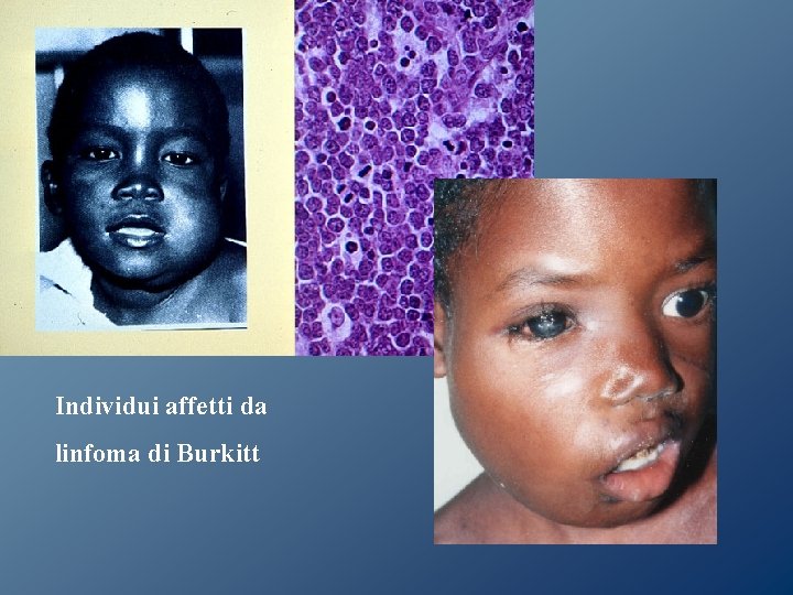 Individui affetti da linfoma di Burkitt Individui affetti da linfoma di Burkitt