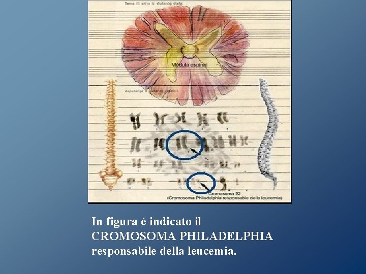 In figura è indicato il CROMOSOMA PHILADELPHIA responsabile della leucemia. In figura è indicato il CROMOSOMA PHILADELPHIA responsabile della leucemia.