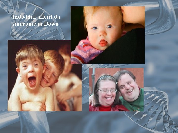 Individui affetti da sindrome di Down Individui affetti da sindrome di Down
