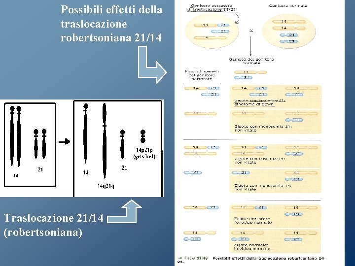 Possibili effetti della traslocazione robertsoniana 21/14 Traslocazione 21/14 (robertsoniana) Possibili effetti della traslocazione robertsoniana 21/14 Traslocazione 21/14 (robertsoniana)