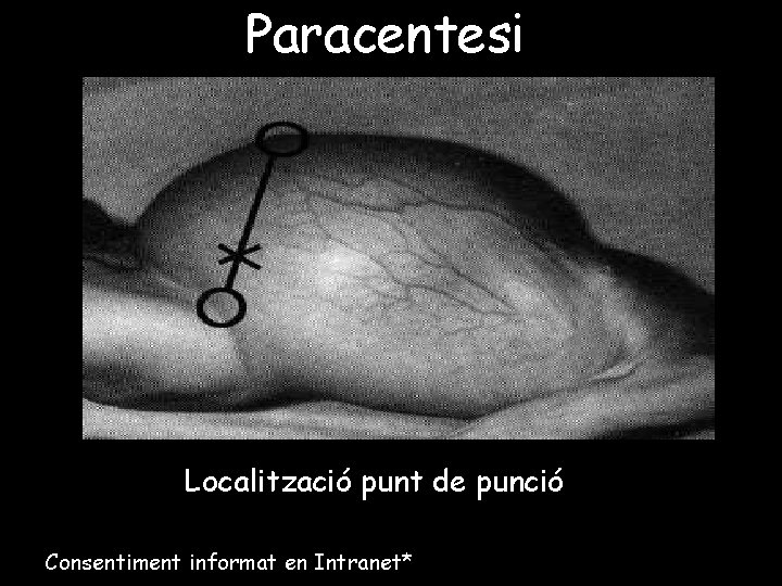 Paracentesi Localització punt de punció Consentiment informat en Intranet* 