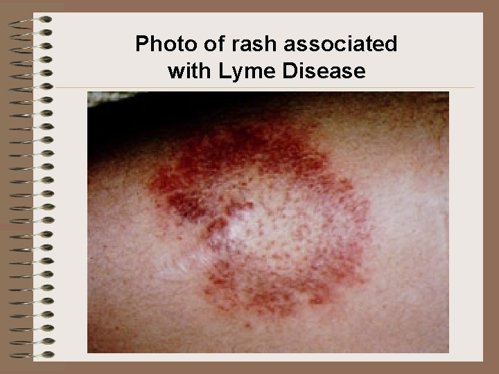Photo of rash associated with Lyme Disease Photo of rash associated with Lyme Disease