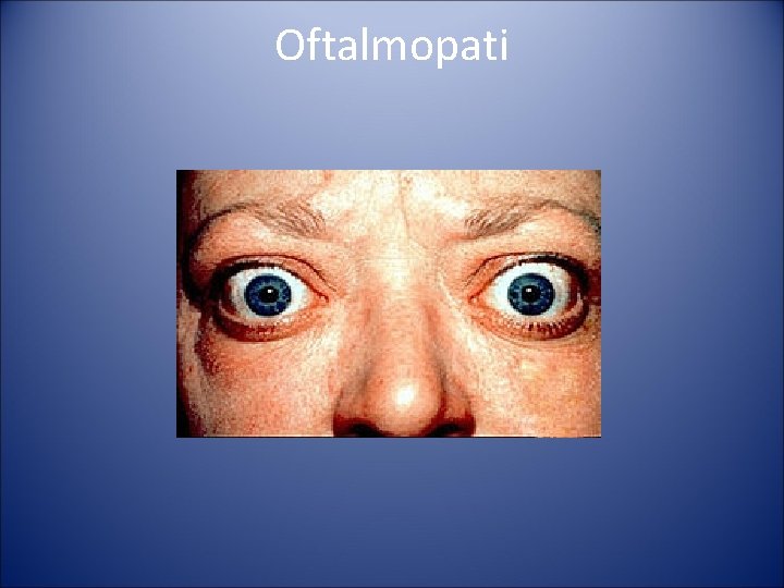 Oftalmopati Oftalmopati