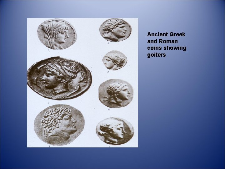 Ancient Greek and Roman coins showing goiters Ancient Greek and Roman coins showing goiters
