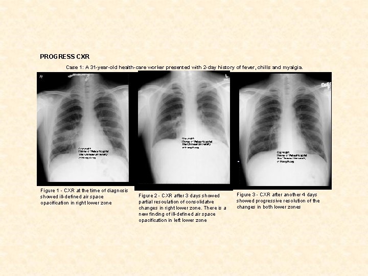 PROGRESS CXR Case 1: A 31 -year-old health-care worker presented with 2 -day history