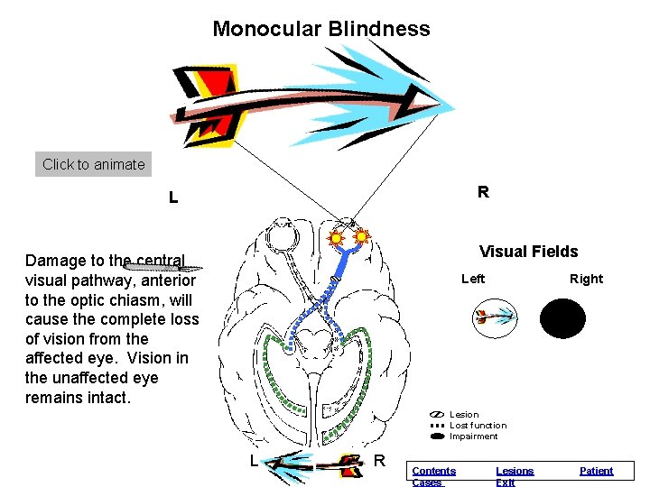 Monocular Normal Blindness Vision Click to animate R L Visual Fields Damage to the Monocular Normal Blindness Vision Click to animate R L Visual Fields Damage to the