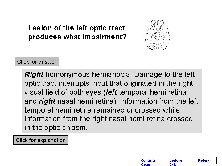 Lesion of the left optic tract produces what impairment? Click for answer Right homonymous Lesion of the left optic tract produces what impairment? Click for answer Right homonymous
