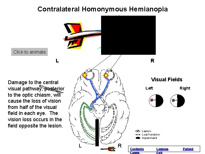 Contralateral. Normal Homonymous Vision Hemianopia Click to animate L R Visual Fields Damage to Contralateral. Normal Homonymous Vision Hemianopia Click to animate L R Visual Fields Damage to