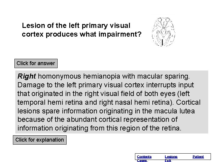 Lesion of the left primary visual cortex produces what impairment? Click for answer Right Lesion of the left primary visual cortex produces what impairment? Click for answer Right