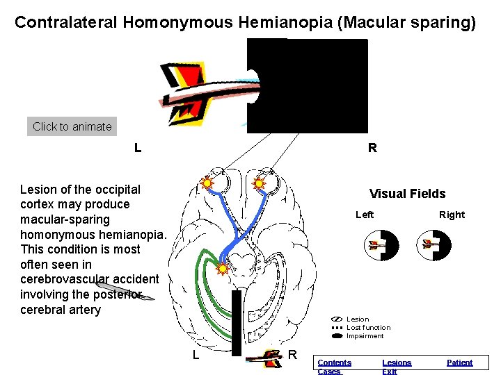 Contralateral Homonymous Hemianopia (Macular sparing) Normal Vision Click to animate L R Lesion of Contralateral Homonymous Hemianopia (Macular sparing) Normal Vision Click to animate L R Lesion of