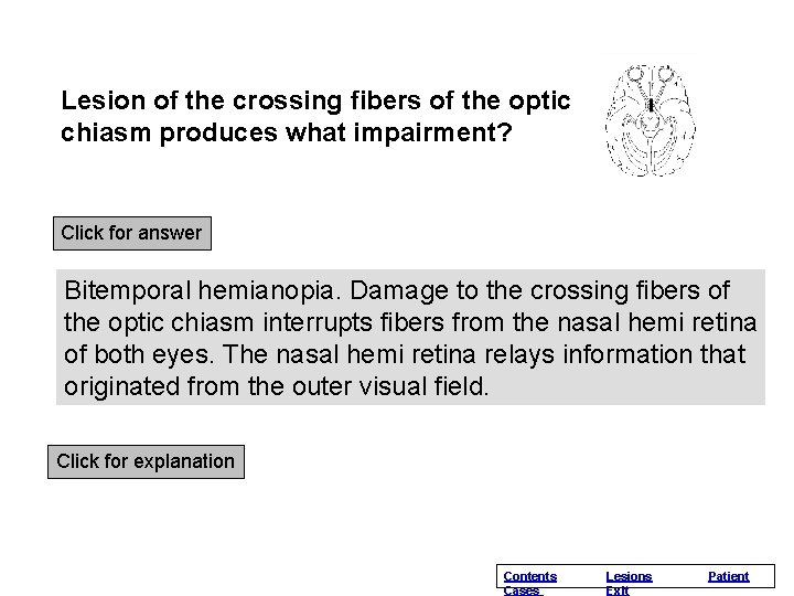 Lesion of the crossing fibers of the optic chiasm produces what impairment? Click for Lesion of the crossing fibers of the optic chiasm produces what impairment? Click for