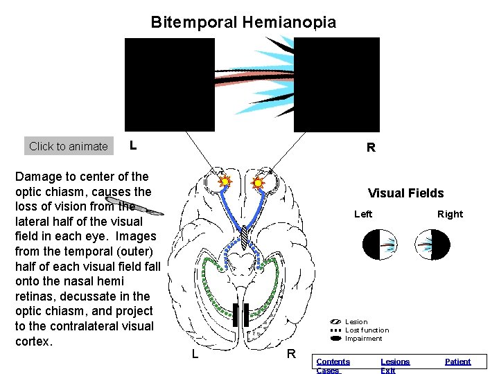 Bitemporal Normal. Hemianopia Vision Click to animate L Damage to center of the optic Bitemporal Normal. Hemianopia Vision Click to animate L Damage to center of the optic