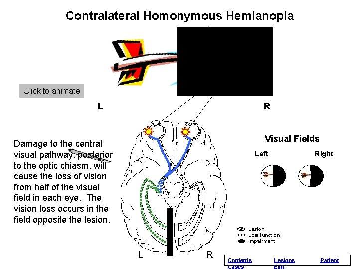 Contralateral. Normal Homonymous Vision Hemianopia Click to animate L R Visual Fields Damage to Contralateral. Normal Homonymous Vision Hemianopia Click to animate L R Visual Fields Damage to