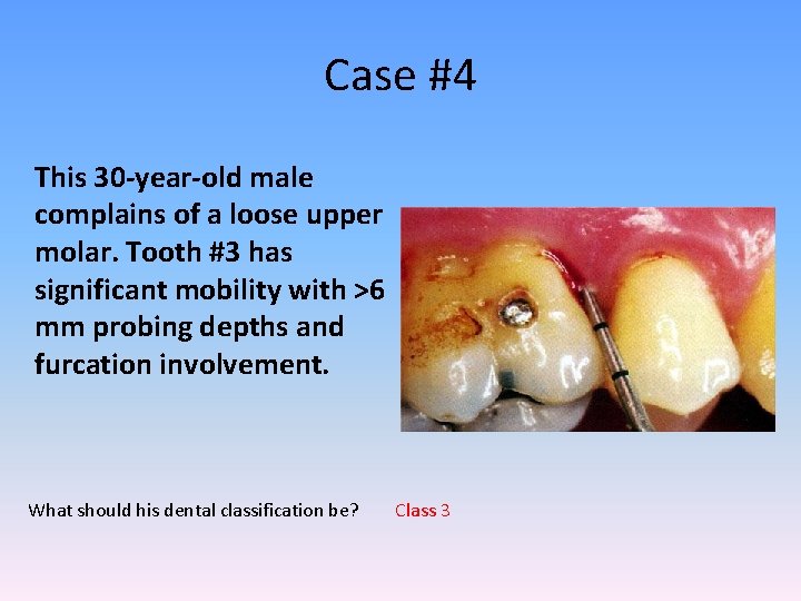 Case #4 This 30 -year-old male complains of a loose upper molar. Tooth #3