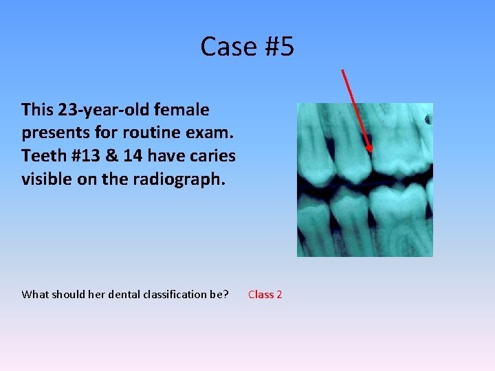 Case #5 This 23 -year-old female presents for routine exam. Teeth #13 & 14