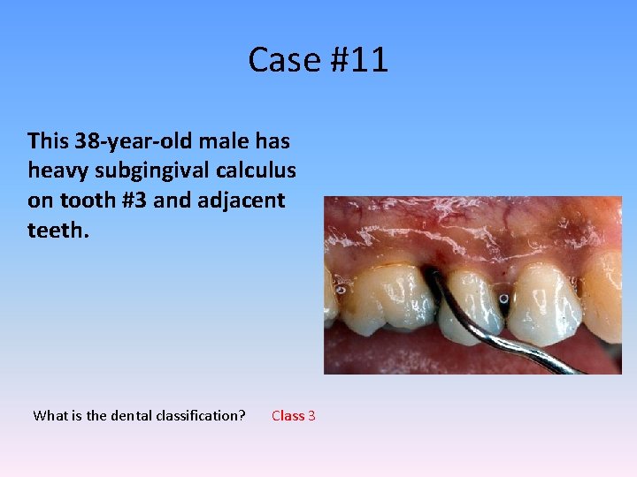 Case #11 This 38 -year-old male has heavy subgingival calculus on tooth #3 and