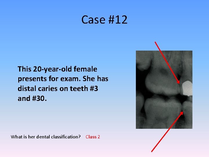 Case #12 This 20 -year-old female presents for exam. She has distal caries on