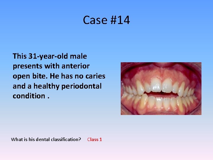 Case #14 This 31 -year-old male presents with anterior open bite. He has no