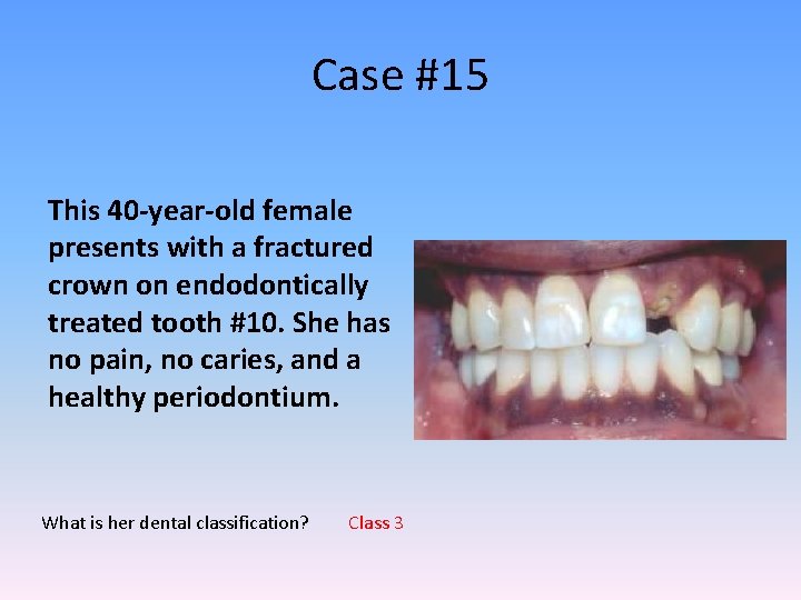 Case #15 This 40 -year-old female presents with a fractured crown on endodontically treated