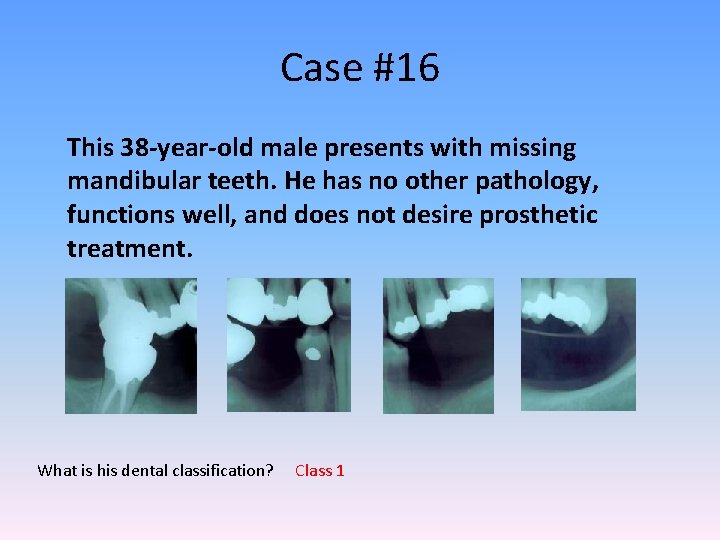 Case #16 This 38 -year-old male presents with missing mandibular teeth. He has no