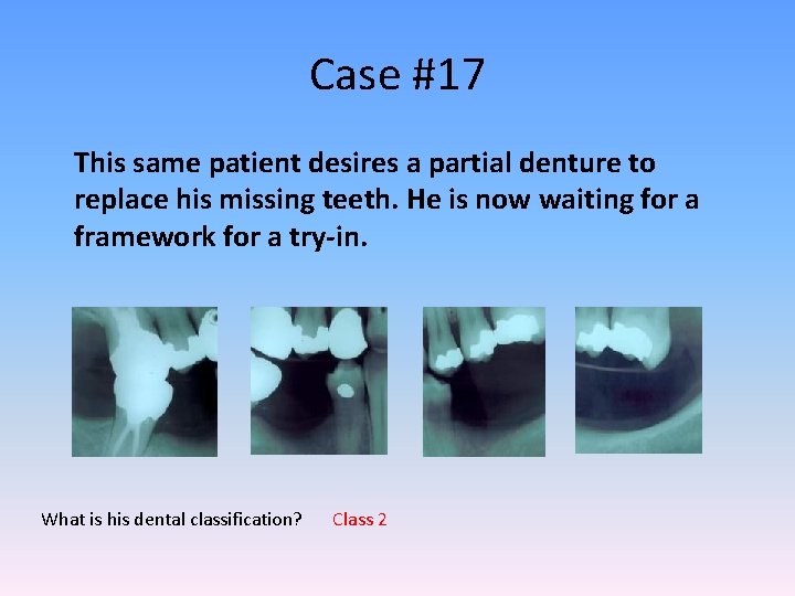 Case #17 This same patient desires a partial denture to replace his missing teeth.