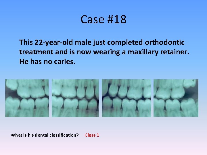 Case #18 This 22 -year-old male just completed orthodontic treatment and is now wearing