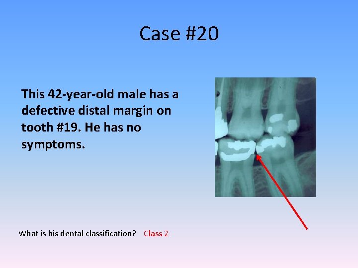 Case #20 This 42 -year-old male has a defective distal margin on tooth #19.