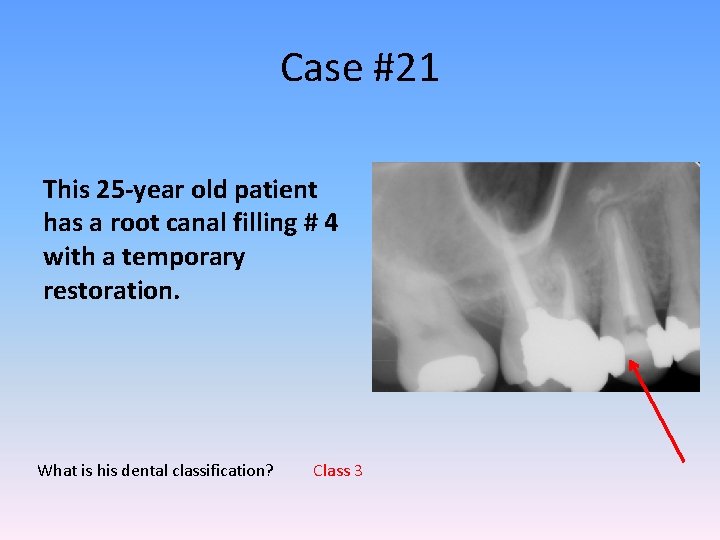 Case #21 This 25 -year old patient has a root canal filling # 4