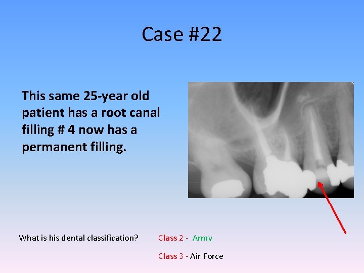 Case #22 This same 25 -year old patient has a root canal filling #