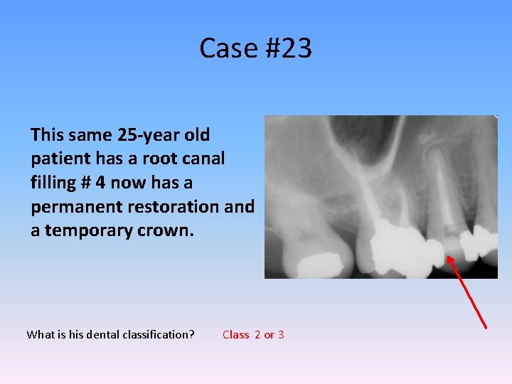 Case #23 This same 25 -year old patient has a root canal filling #