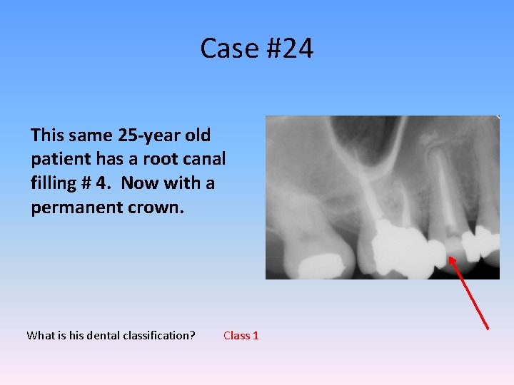 Case #24 This same 25 -year old patient has a root canal filling #