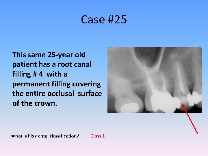 Case #25 This same 25 -year old patient has a root canal filling #