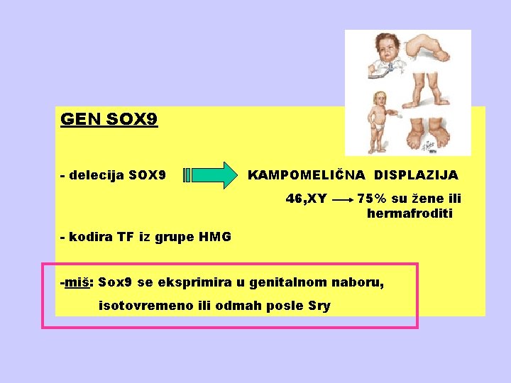 GEN SOX 9 - delecija SOX 9 KAMPOMELIČNA DISPLAZIJA 46, XY 75% su žene