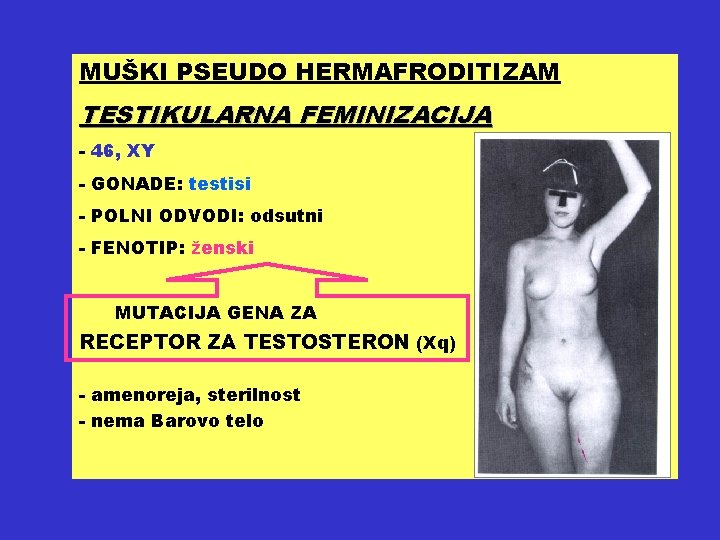 MUŠKI PSEUDO HERMAFRODITIZAM TESTIKULARNA FEMINIZACIJA - 46, XY - GONADE: testisi - POLNI ODVODI: