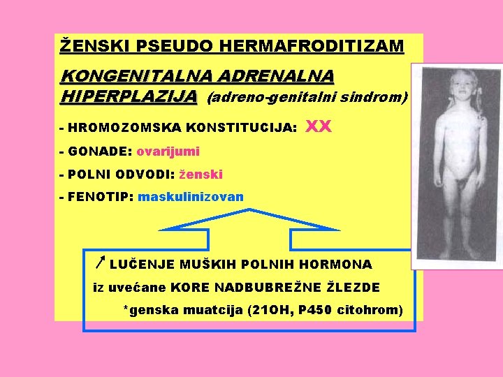 ŽENSKI PSEUDO HERMAFRODITIZAM KONGENITALNA ADRENALNA HIPERPLAZIJA (adreno-genitalni sindrom) - HROMOZOMSKA KONSTITUCIJA: XX - GONADE: