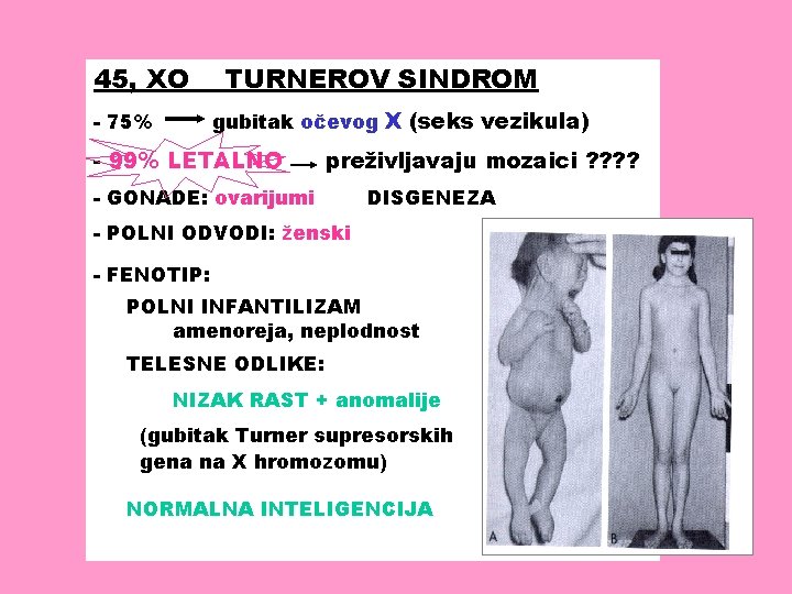 45, XO TURNEROV SINDROM gubitak očevog X (seks vezikula) - 75% - 99% LETALNO