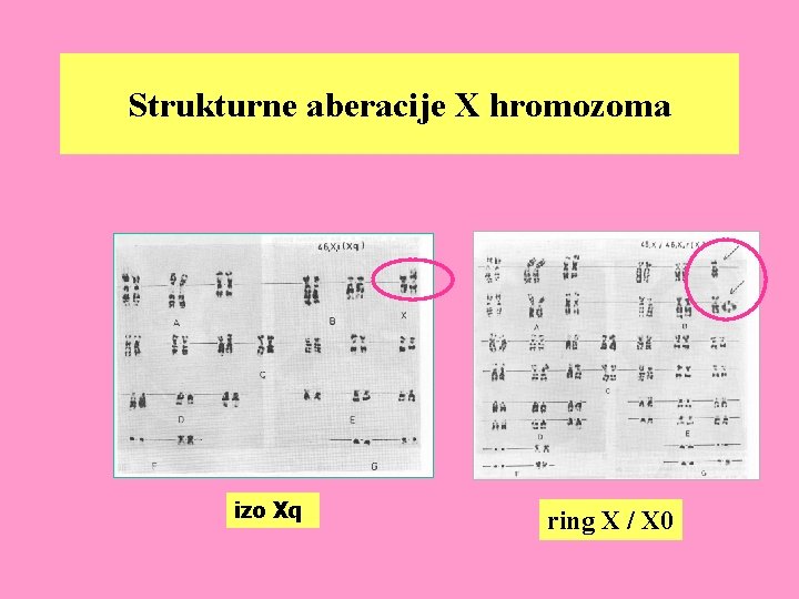 Strukturne aberacije X hromozoma izo Xq ring X / X 0 