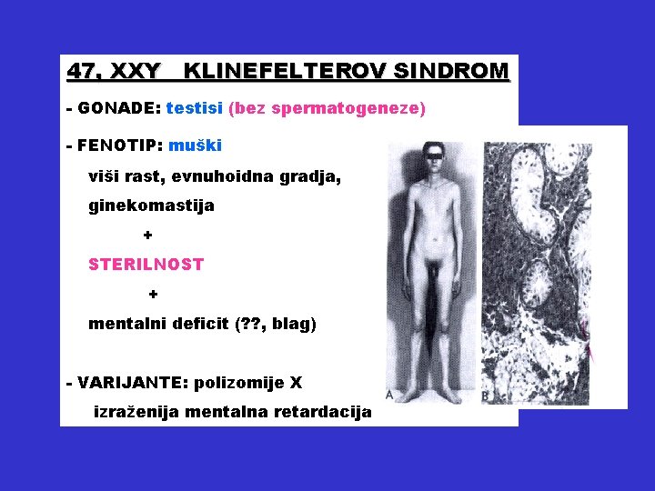 47, XXY KLINEFELTEROV SINDROM - GONADE: testisi (bez spermatogeneze) - FENOTIP: muški viši rast,