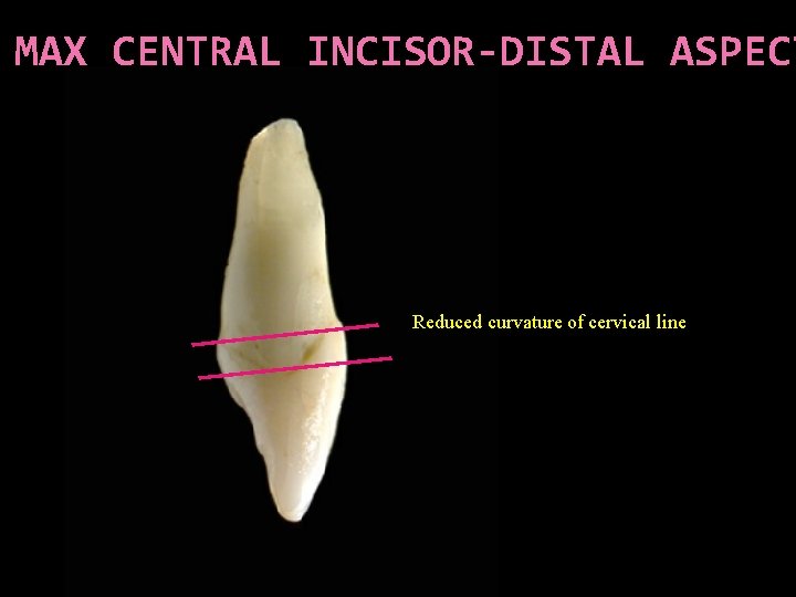 MAX CENTRAL INCISOR-DISTAL ASPECT Reduced curvature of cervical line 