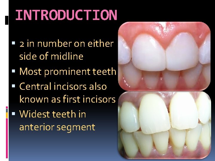 INTRODUCTION 2 in number on either side of midline Most prominent teeth Central incisors