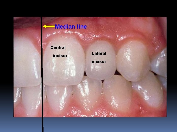 Median line Central incisor Lateral incisor 