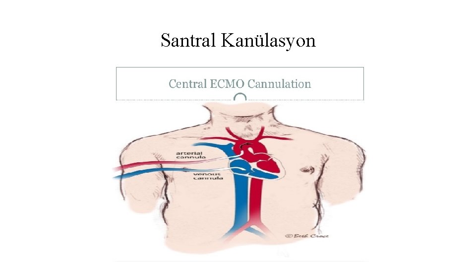 Santral Kanülasyon Santral Kanülasyon