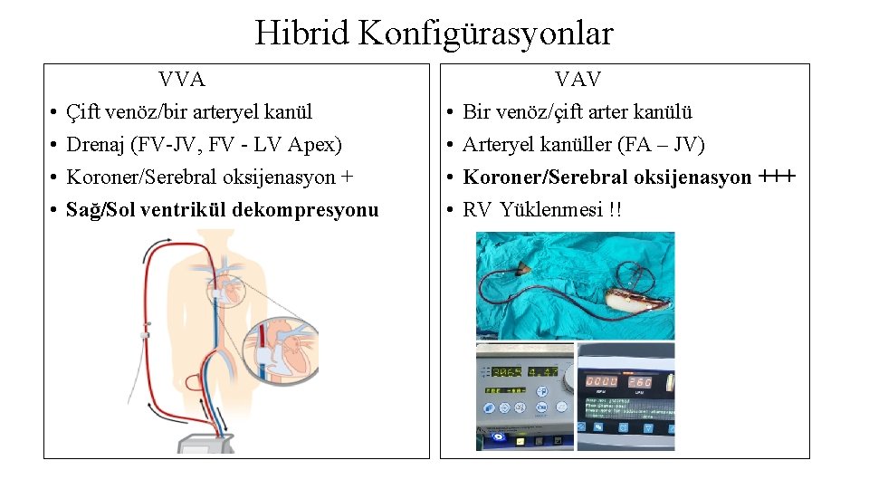 Hibrid Konfigürasyonlar • • VVA Çift venöz/bir arteryel kanül Drenaj (FV-JV, FV - LV Hibrid Konfigürasyonlar • • VVA Çift venöz/bir arteryel kanül Drenaj (FV-JV, FV - LV