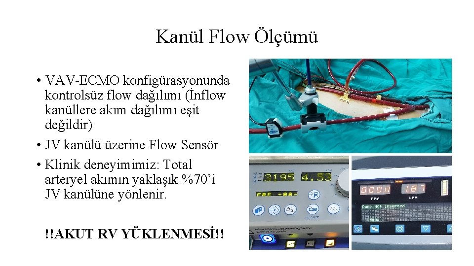 Kanül Flow Ölçümü • VAV-ECMO konfigürasyonunda kontrolsüz flow dağılımı (İnflow kanüllere akım dağılımı eşit Kanül Flow Ölçümü • VAV-ECMO konfigürasyonunda kontrolsüz flow dağılımı (İnflow kanüllere akım dağılımı eşit