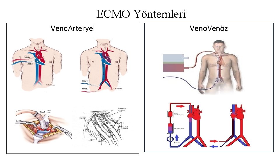 ECMO Yöntemleri Veno. Arteryel Veno. Venöz ECMO Yöntemleri Veno. Arteryel Veno. Venöz