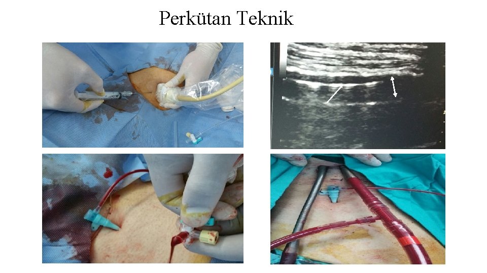 Perkütan Teknik Perkütan Teknik