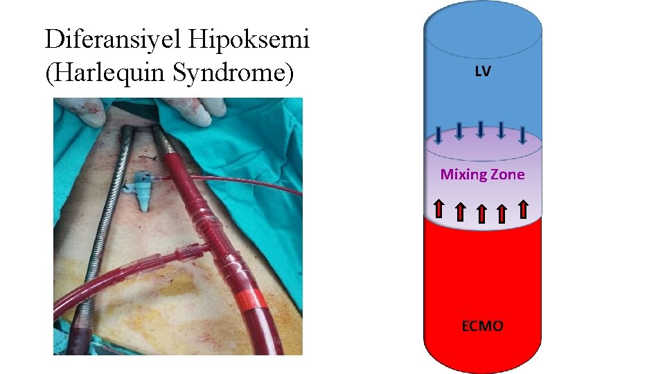 Diferansiyel Hipoksemi (Harlequin Syndrome) LV Mixing Zone ECMO Diferansiyel Hipoksemi (Harlequin Syndrome) LV Mixing Zone ECMO